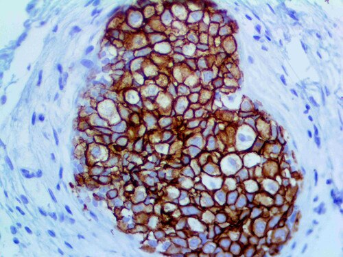 HER-2 neu Antibody Immunohistochemistry on a FFPE Breast Carcinoma Tissue